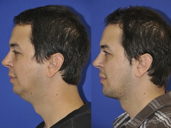 Chin augmentation before and after