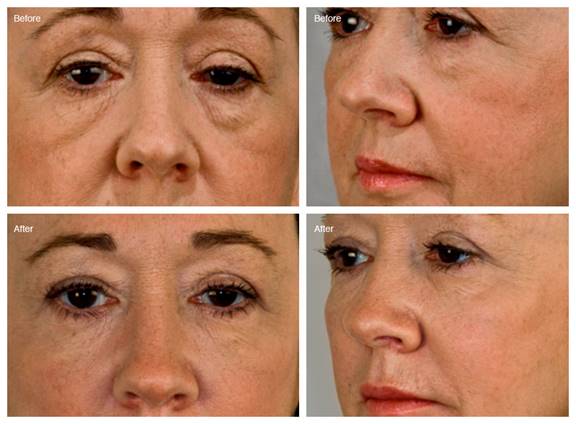 bags under eyes