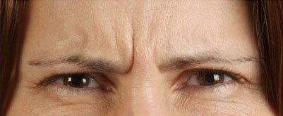 Botox Before Treatment