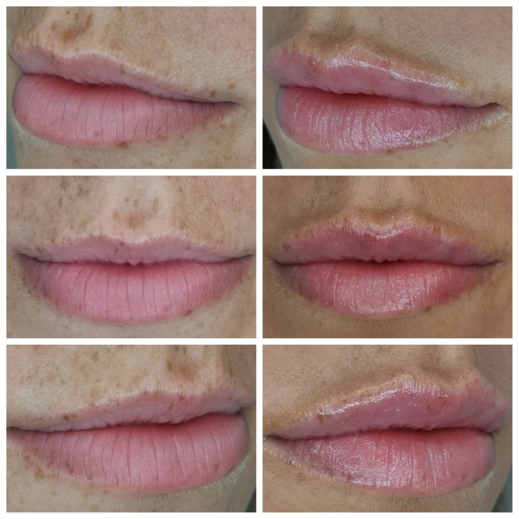 Lip Sculpting