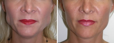 Teeth Grinding (Bruxism)